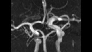 LIVE  flow diverter  fusiform aneurysm ICA [upl. by Dawkins]