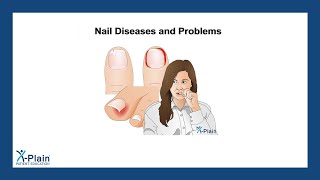 Nail Diseases and Problems [upl. by Eyahc178]