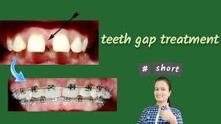 teeth gap treatment  Braces [upl. by Donovan261]