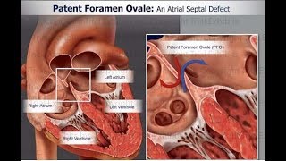 Patent foramen ovale PFO Part II [upl. by Glenna]