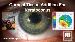 Corneal Tissue Addition For Keratoconus CTAK [upl. by Thorr469]