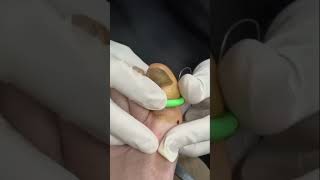 How to treat Toenail Fungus🤯 [upl. by Bottali629]