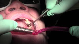 Canker sore treatment and relief at Sana Dental in Edmonton [upl. by Eddy663]