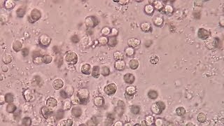 uti  pus cells  bacteria  urine analyses [upl. by Abdulla927]