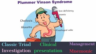 Classic Triad of Plummer Vinson Syndrome  Easy Mnemonic to REMEMBER [upl. by Wallis]