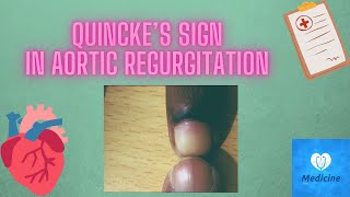 Quincke’s sign  Aortic regurgitation  medicine physical examination [upl. by Analahs377]