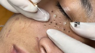 Blackhead Treatment right under the eyes [upl. by Giordano718]