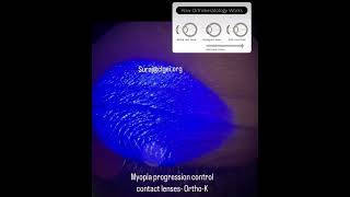 Orthokeratology lens for controlling the myopia progression contactlens orthokeratology [upl. by Johen231]