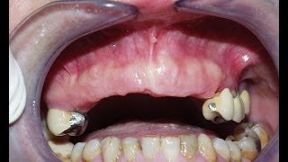 Implantes Dentales T5 [upl. by Moulton83]