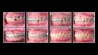 Gummy Smile Treatment Live [upl. by Htebyram]