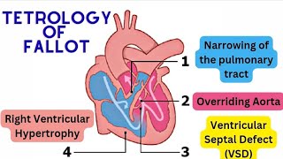 Tetralogy of Fallot The 4 Components Explained [upl. by Eniamor]