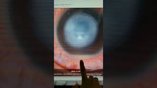 hypopyon corneal ulcers diagnosis optometrists treatments eye oci keratoconus ophthalmology [upl. by Osnofledi]