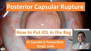 Posterior capsular ruptureRentHow to insert IOL in bag thinking process Dr Sourabh Patwardhan [upl. by Tabb]