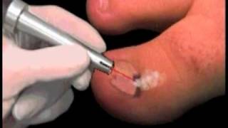 Laser Treatment for Ingrown Toenails in NYC [upl. by Florenza]