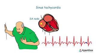 Sinus Tachycardia  A condition with fasterthanusual heart rhythm [upl. by Cuthbert119]