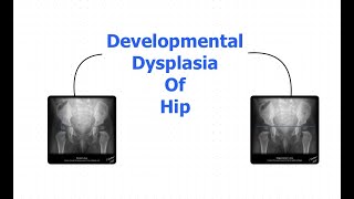 Developmental dysplasia of hip [upl. by Eikram373]