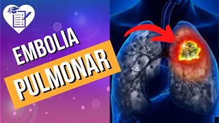 O que é Embolia Pulmonar Sintomas e Tratamentos [upl. by Haff404]