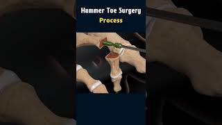 Hammer Toe Surgery Understanding the Procedure surgeryanimation [upl. by Bradleigh]