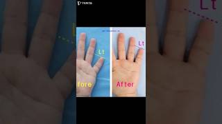 brachydactyly brachydactylytypeD 短指症手術 短指症 大拇指短粗 マムシ指 しゃもじ指 まむし指 우렁손톱 단지증 단지증수술 단지증수술후기 [upl. by Holloway]