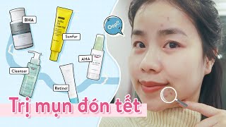 Trị Mụn Nhanh Trong Một Tháng ♡ Quin [upl. by Llerroj]