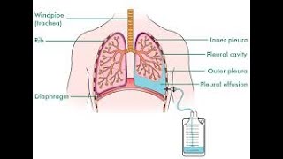 drainage pleural [upl. by Aurelius303]