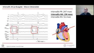 Come appare il ritmo sinusale  parametri ed intervalli di riferimento [upl. by Nohtanoj]