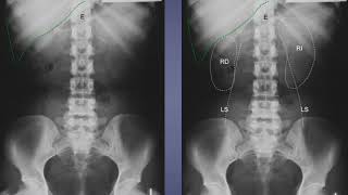 Radiografía simple de abdomen [upl. by Aleehs]