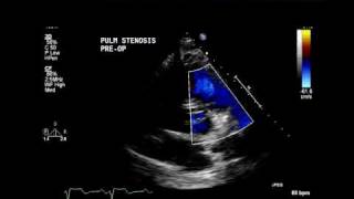 Moderate Pulmonary stenosis [upl. by Eneles]