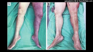 Phlegmasia Cerulea Dolens with Compartment Syndrome [upl. by Ayhtin]