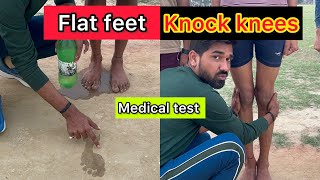 What is Knock Knee How to solve Knock Knee problem for Medical in Army Air Force and Navy [upl. by Aisayt]