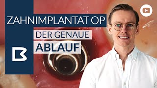 Zahnimplantat OP  Der genaue Ablauf [upl. by Isleen]