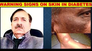 WARNING SIGNS THAT APPEAR ON SKIN in DIABETES Lectures by Dr Alamzeb [upl. by Neelie807]