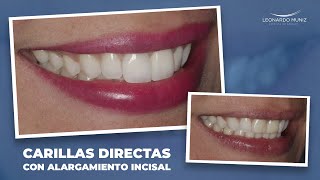 CARILLAS CON ALARGAMIENTOS INCISALES EN DIENTES OSCUROS [upl. by Anaz]