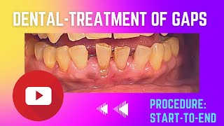 Dental Treatment for loose weak and spacedout teeth Joined Crowns [upl. by Tatum]