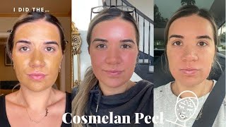 The Cosmelan Peel II My 1st Chemical Peel in Over TWO Years [upl. by Annaoi]