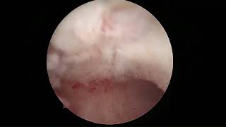 HYSTEROSCOPIC CURETTAGE [upl. by Ximenez45]