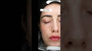 Facial Revolumization with Fat  Fat Transfer to Temples amp Cheekbones  Dr Kami Parsa [upl. by Navis]