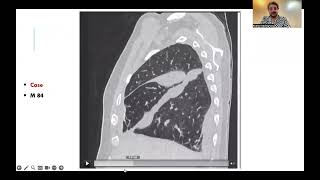 Interstitial pulmonary edema with fissural effusion Arabic version [upl. by Claudie811]