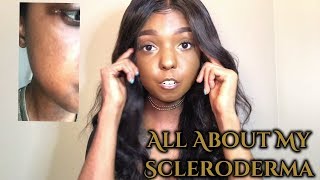 Living With Scleroderma  All about my scleroderma [upl. by Beaver355]