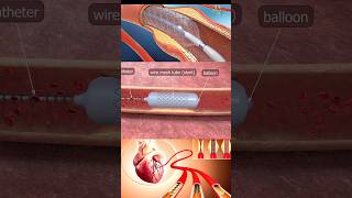 Coronary angioplasty  heart angiogram angioplasty heartattack nursingking [upl. by Stephanus]