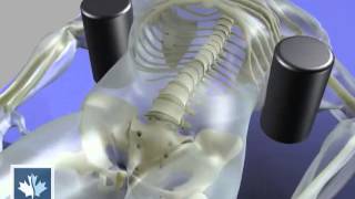 Sciatica  Spinal Decompression  Back Clinics of Canada [upl. by Tiana906]