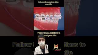 OPEN BITE BRACESORTHODONTICS oralhealth viral smile trending youtubeshorts shorts [upl. by Anirret]