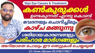 Get rid of Eye stye  കൺകുരു മാറാൻ എളുപ്പവഴി  Eye Stye  Causes and Treatment  Dr Visakh kadakkal [upl. by Anived]