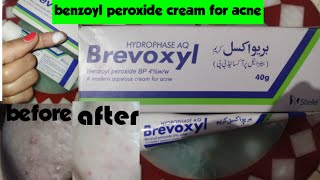 Brevoxyl 4 cream review  benzoyl peroxide cream  benzoyl peroxide cream for acne  bloom by anam [upl. by Ariajaj]