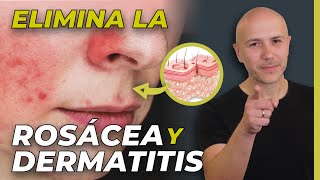 Rosácea Y Dermatitis Así Se Cura  Dr Carlos Jaramillo [upl. by Elijah]