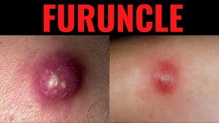 What is Furuncle Furuncle Boil DefinitionCauses Symptoms Risk Factors USMLE [upl. by Anaibaf]