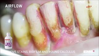 GBT Step 04 Stains biofilm and young calculus removal with AIRFLOW® and PLUS powder [upl. by Enialedam]