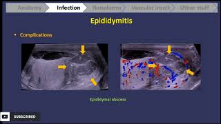 scrotal ultrasound  everything u should know  part 1 [upl. by Rahab]