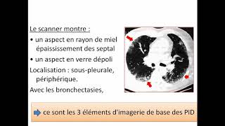 Cas clinique ECN en pneumologie  Résumé de PNEUMOPATHIES INFILTRATIVES DIFFUSES PID [upl. by Elfreda]