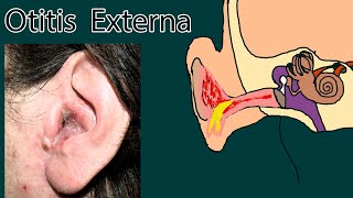 Swimmers Ear Otitis Externa Causes Diagnosis Treatment [upl. by Wynny]